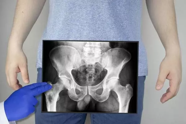 рентген подвздошной кости