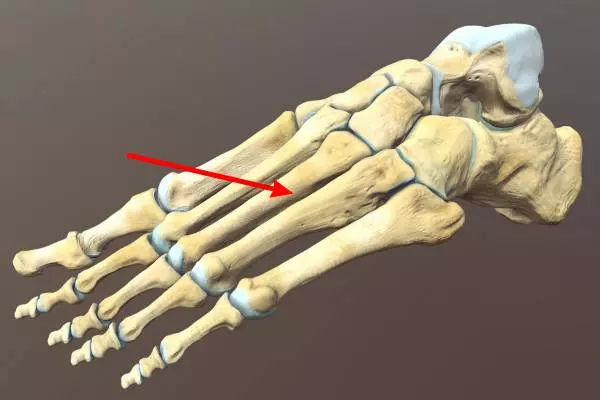 Плюсневая кость стопы где находится перелом